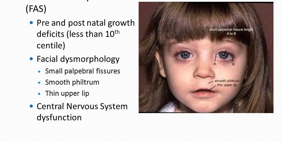 Sample Project Fetal Alcohol Syndrome 